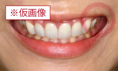 バランス歯肉整形after