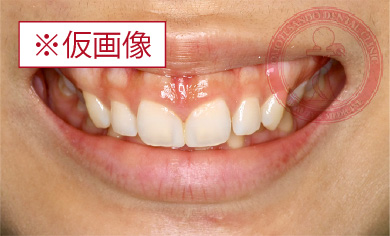 歯肉整形before