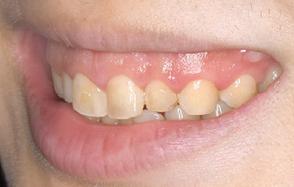 ガミースマイルの画像