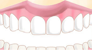 ワイヤー矯正after