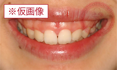 ワイヤー矯正before