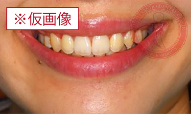 ワイヤー矯正after